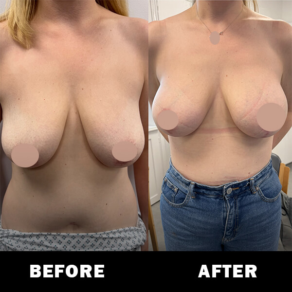 Before and After Breast Augmentation and Uplift 1