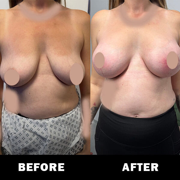 Before and After breast aug and uplift 2