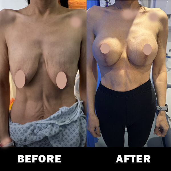 Before and After breast aug and uplift 4