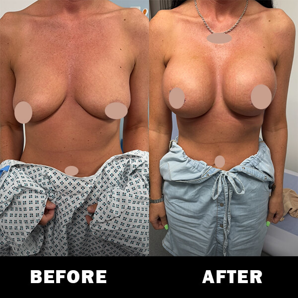 Before and after breast aug and uplift 9