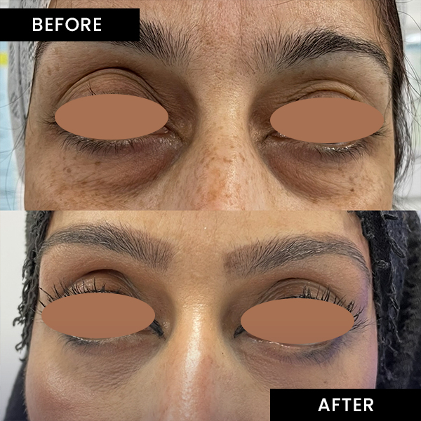 Blepharoplasty-2