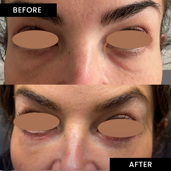 Blepharoplasty-3