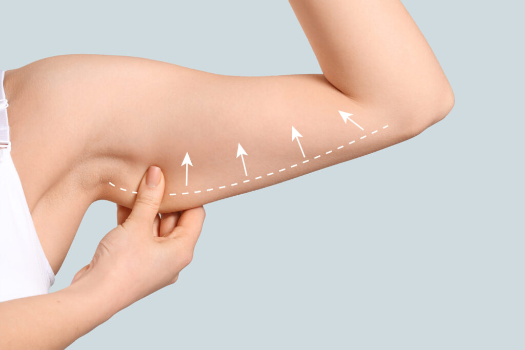 Arm Lift Surgery in Salford