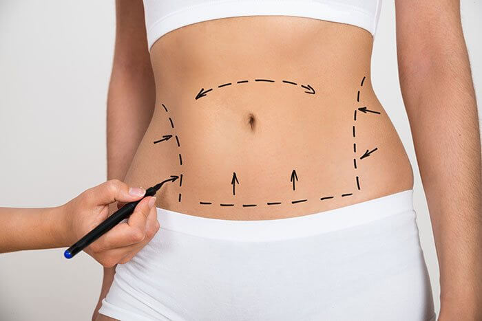 Liposuction Surgery in Salford
