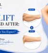 Arm Lift Before and After